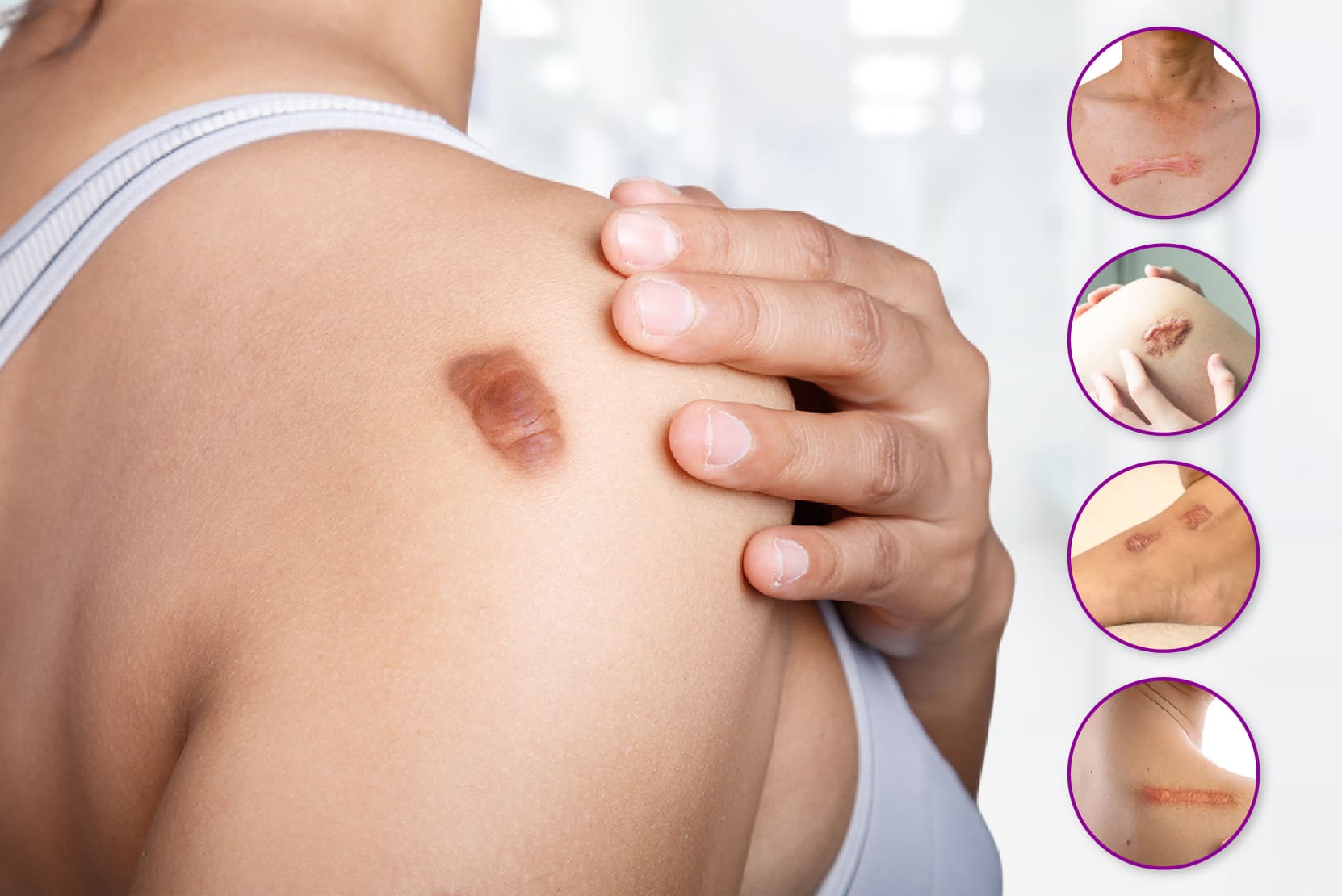 Keloid